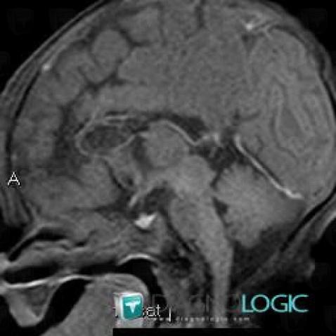 Agenesis-corpus callosum, Corpus callosum, MRI