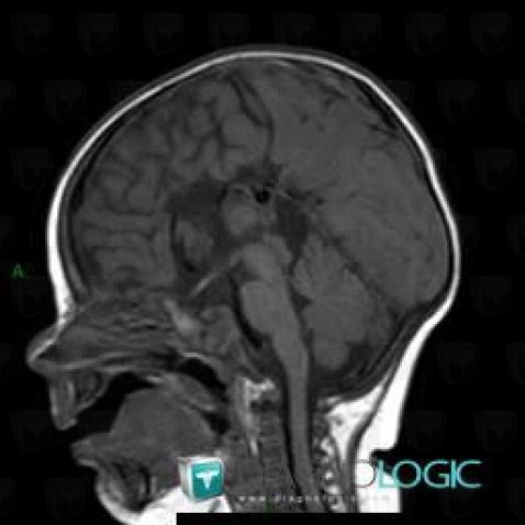 Agenesis-corpus callosum, Corpus callosum, MRI