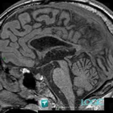 Agenesis-corpus callosum, Corpus callosum, MRI