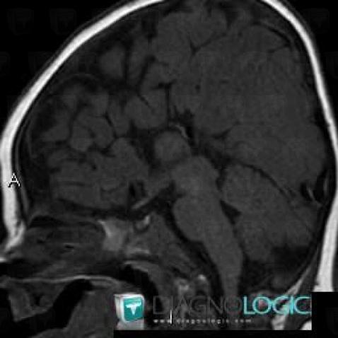 Agenesis-corpus callosum, Corpus callosum, MRI