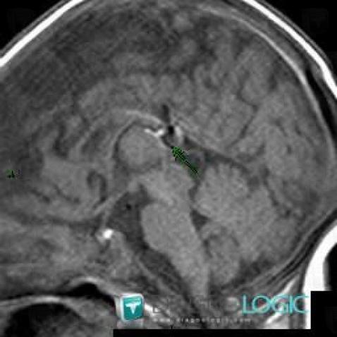 Agenesis-corpus callosum, Corpus callosum, MRI