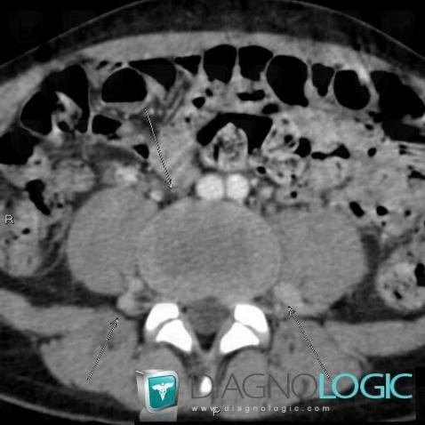 Agenesis-the inferior vena cava, Inferior vena cava, CT