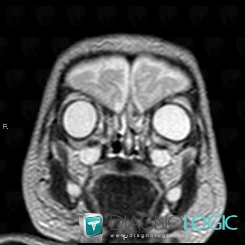 Agenesis-the olfactory bulbs, Cerebral hemispheres, MRI