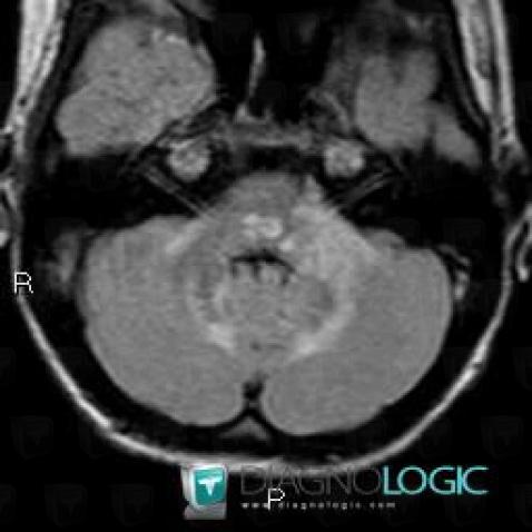 Alexander’s disease, Brainstem, Cerebellar hemisphere, MRI