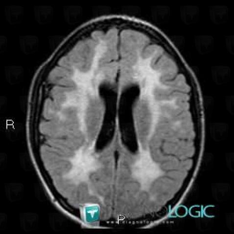 Alexander’s disease, Cerebral hemispheres, Ventricles / Periventricular region, MRI
