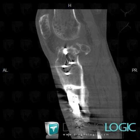 Algodystrophie, Articulation fémoro patellaire, Scanner