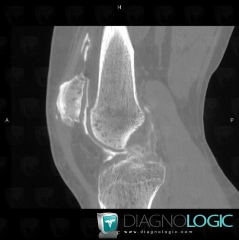 Algodystrophie, Articulation fémoro patellaire, Scanner