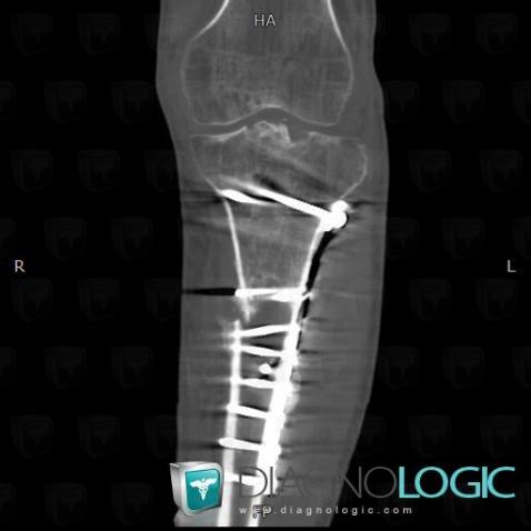Algodystrophie, Articulations fémoro tibiales / Echancrure, Scanner