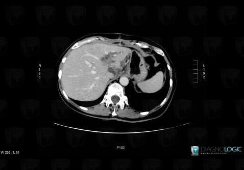 Alveolar echinococcosis, Liver, CT