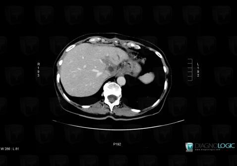 Alveolar echinococcosis, Liver, CT