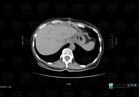 Alveolar echinococcosis, Liver, CT