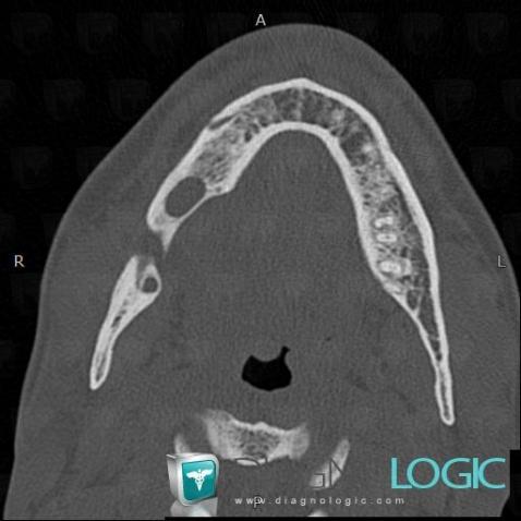 Ameloblastoma, Mandible, CT