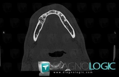 Ameloblastoma, Mandible, CT