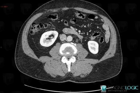 Ampullary carcinoma, Duodenum, CT