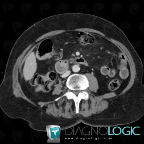 Ampullary carcinoma, Duodenum, CT