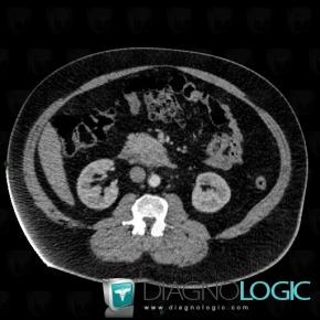 Ampullary carcinoma, Duodenum, CT