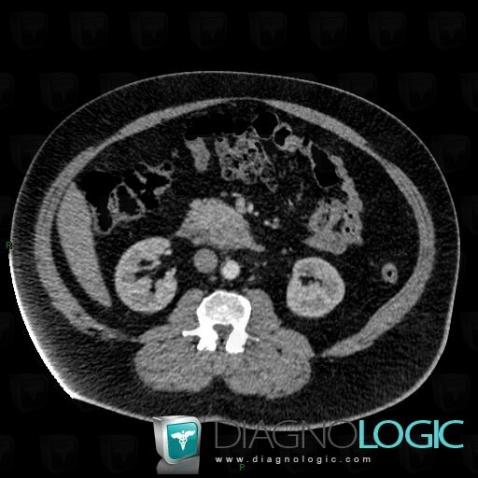 Ampullary carcinoma, Duodenum, CT