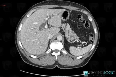 Ampullary carcinoma, Intra and extra hepatic bile ducts, CT