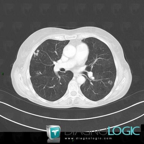 Amyloidosis, Pulmonary parenchyma, CT