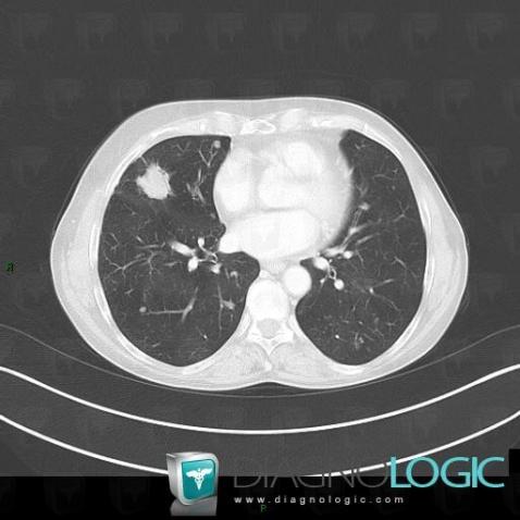 Amyloidosis, Pulmonary parenchyma, CT