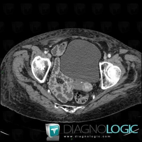 Amyloidosis, Small bowel, CT