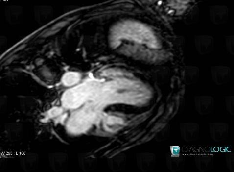 Amylose , Cavités cardiaques / Péricarde, IRM