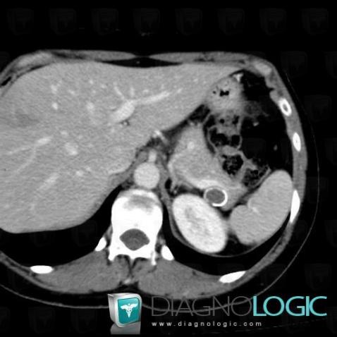 Aneurysm, Abdominal aorta branches, CT