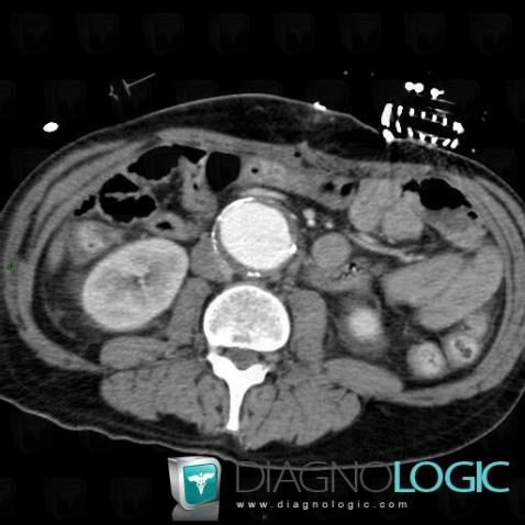 Aneurysm, Abdominal aorta, CT