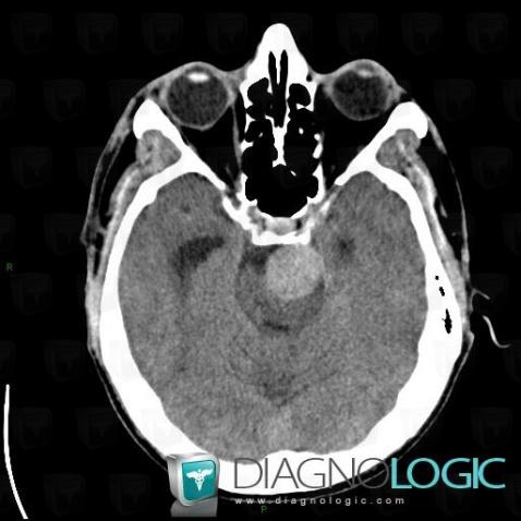 Aneurysm, Cerebellopontine angle, Infratentorial peri cerebral spaces, CT