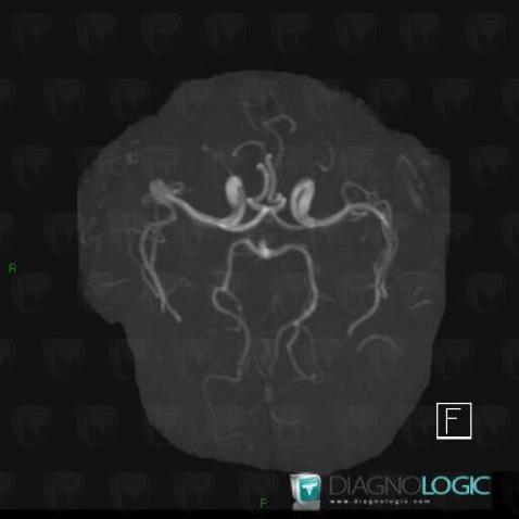 Aneurysm, Cerebral arteries, MRI