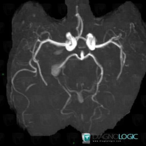 Aneurysm, Cerebral arteries, MRI