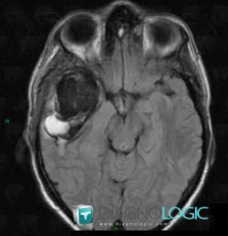 Aneurysm, Cerebral arteries, MRI