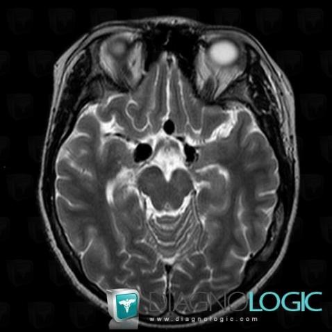 Aneurysm, Cerebral arteries, MRI