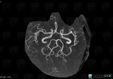 Aneurysm, Cerebral arteries, MRI