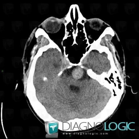 Aneurysm, Cerebral falx / Midline, CT