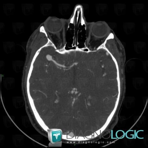 Aneurysm, Cerebral hemispheres, Cerebral arteries, CT