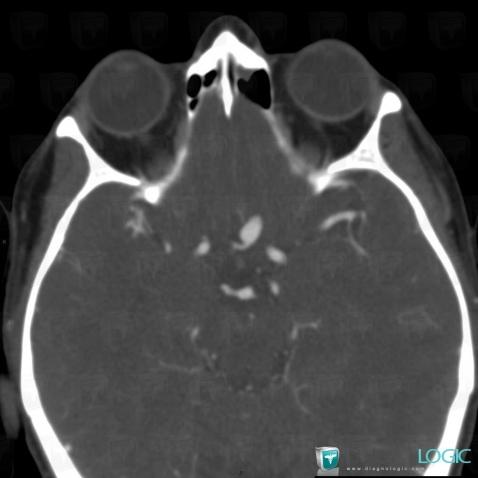 Aneurysm, Cerebral hemispheres, Cerebral arteries, CT