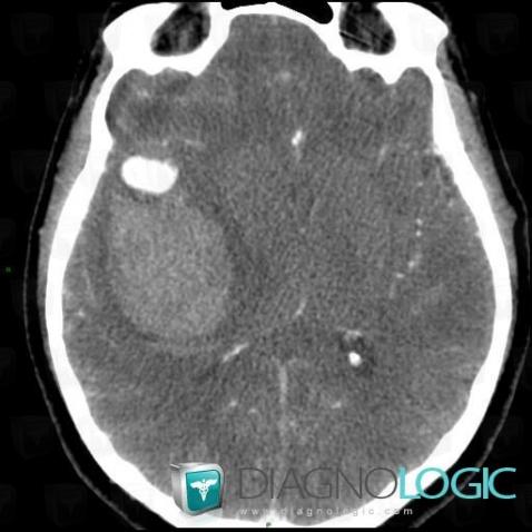 Aneurysm, Cerebral hemispheres, CT