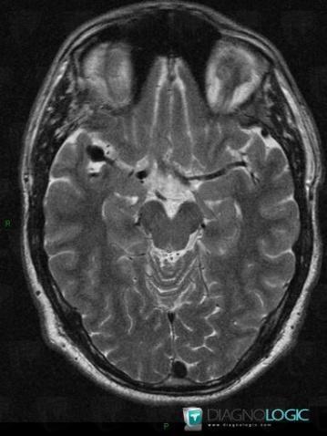 Aneurysm, Cerebral hemispheres, MRI