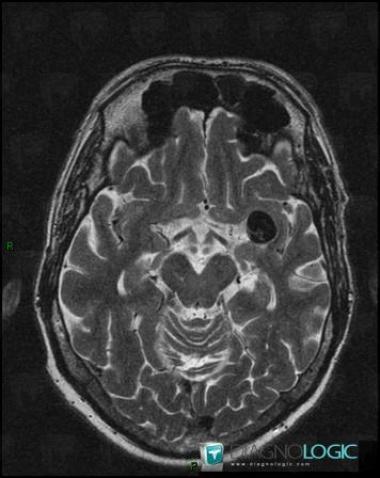 Aneurysm, Cerebral hemispheres, MRI