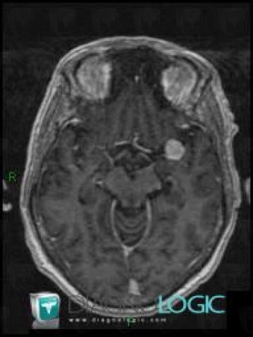 Aneurysm, Cerebral hemispheres, MRI