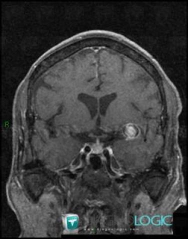 Aneurysm, Cerebral hemispheres, MRI