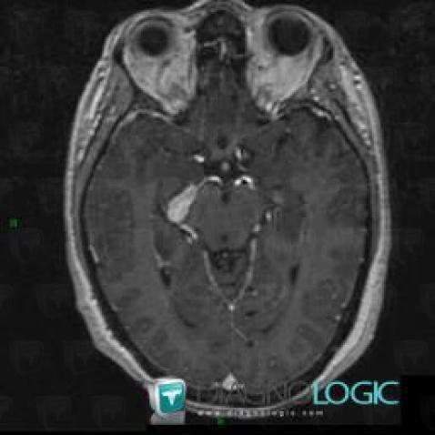 Aneurysm, Cerebral hemispheres, MRI