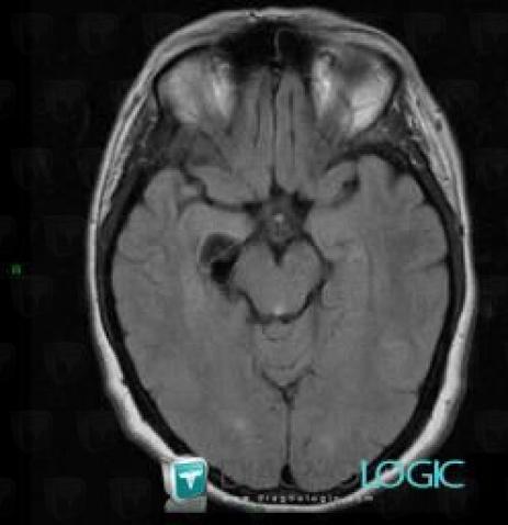 Aneurysm, Cerebral hemispheres, MRI