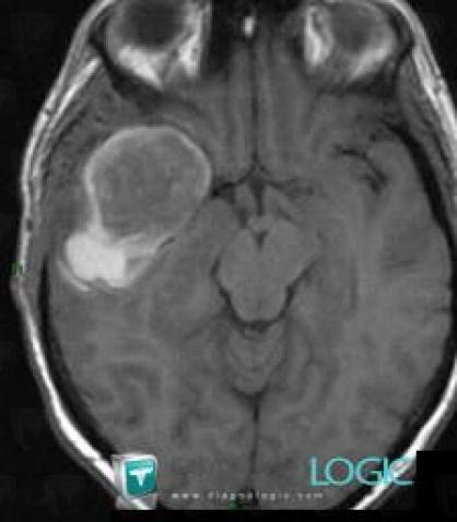 Aneurysm, Cerebral hemispheres, MRI