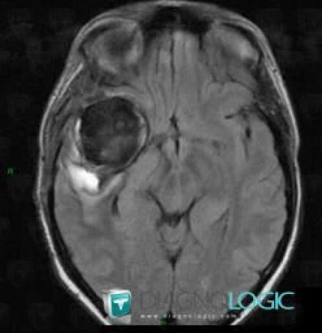 Aneurysm, Cerebral hemispheres, MRI