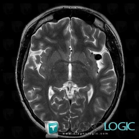 Aneurysm, Cerebral hemispheres, MRI