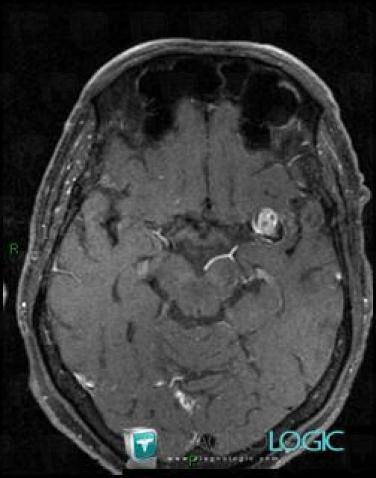 Aneurysm, Cerebral hemispheres, Posterior fossa, MRI