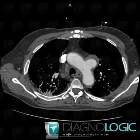 Aneurysm, Mediastinum, Aorta, CT