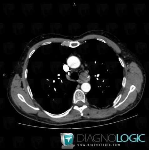 Aneurysm, Mediastinum, CT